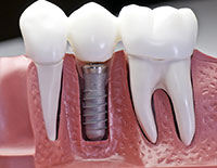side view of dental implant in a mouth